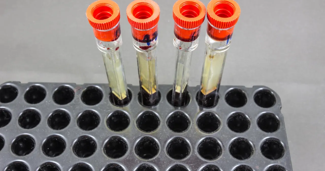 badanie krwi OB prob&oacute;wka