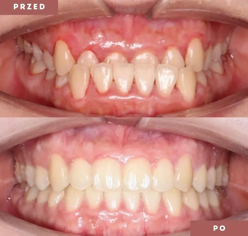 przezroczyste nakładki ortodontyczne przed i po