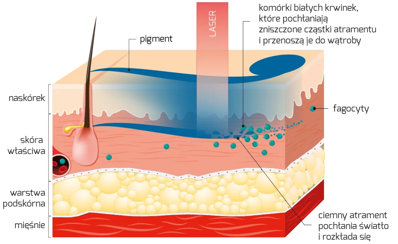 por&oacute;wnanie lasera medycznego i kosmetycznego
