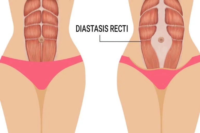 rozejście mięśnia prostego brzucha ilustracja
