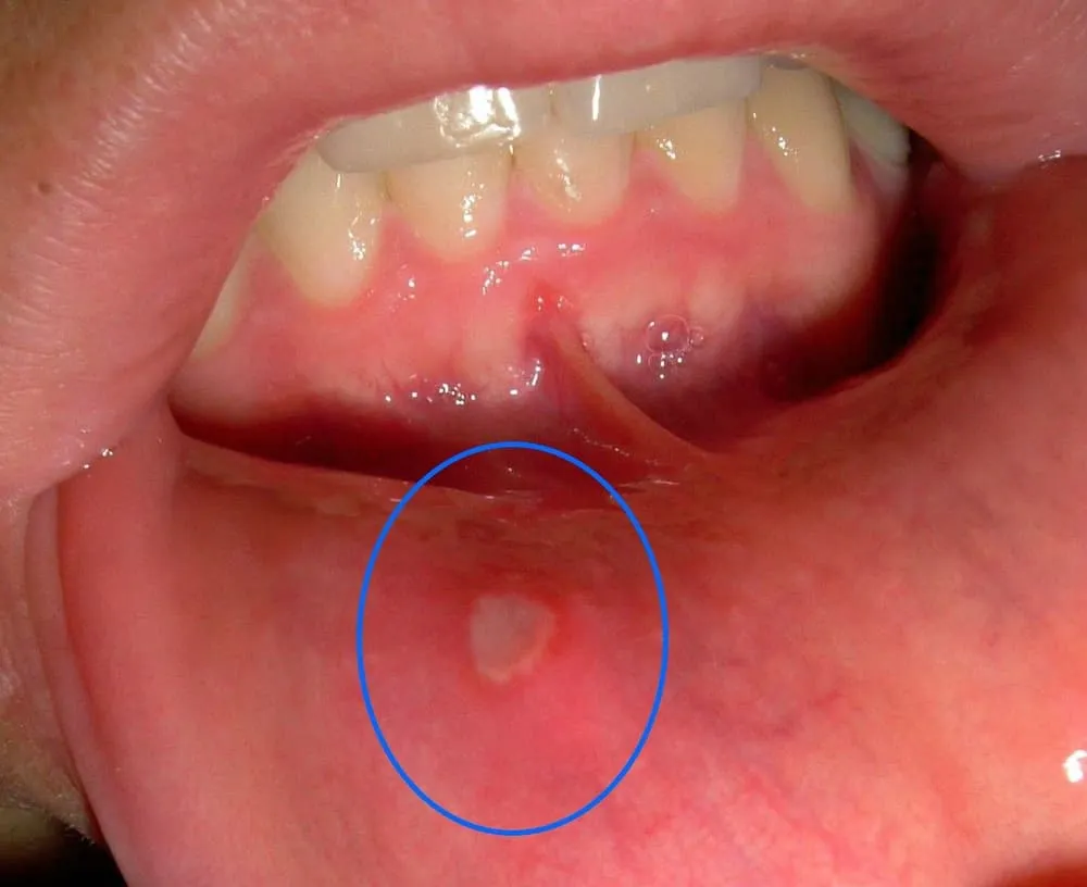 Afta na dziąśle zdjęcia r&oacute;żne stadia
