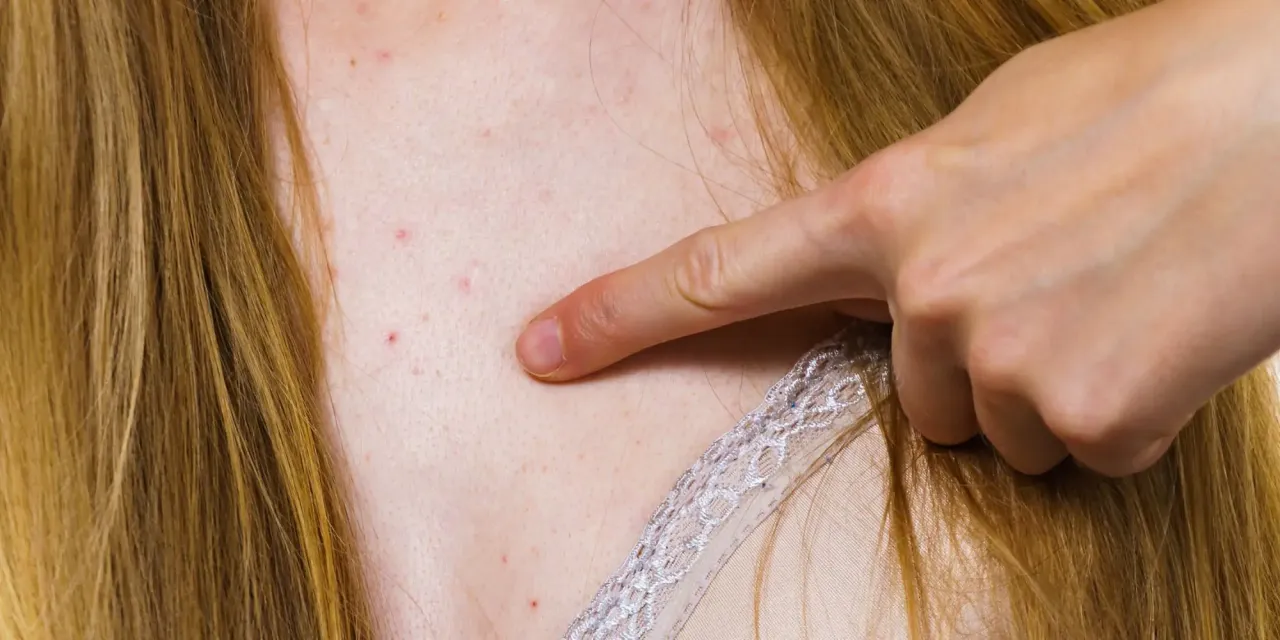 składniki aktywne na pryszcze dekolt