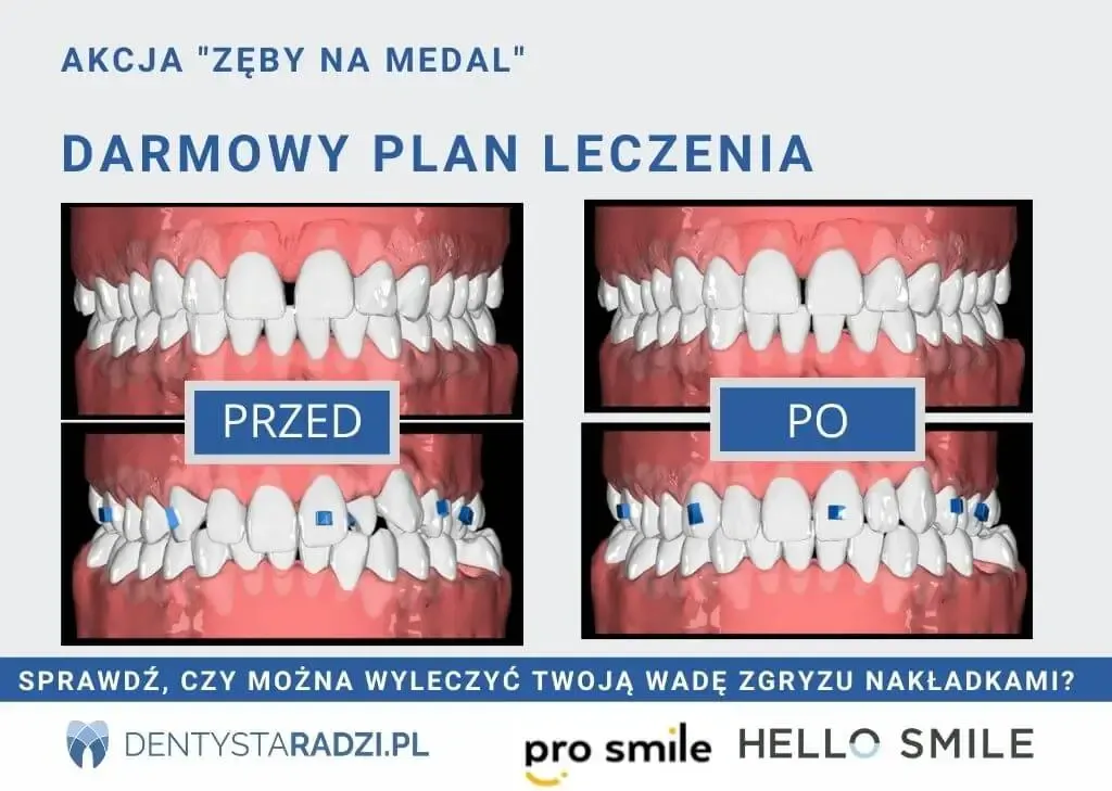 wizualizacja leczenia nakładkami ortodontycznymi planowanie cyfrowe