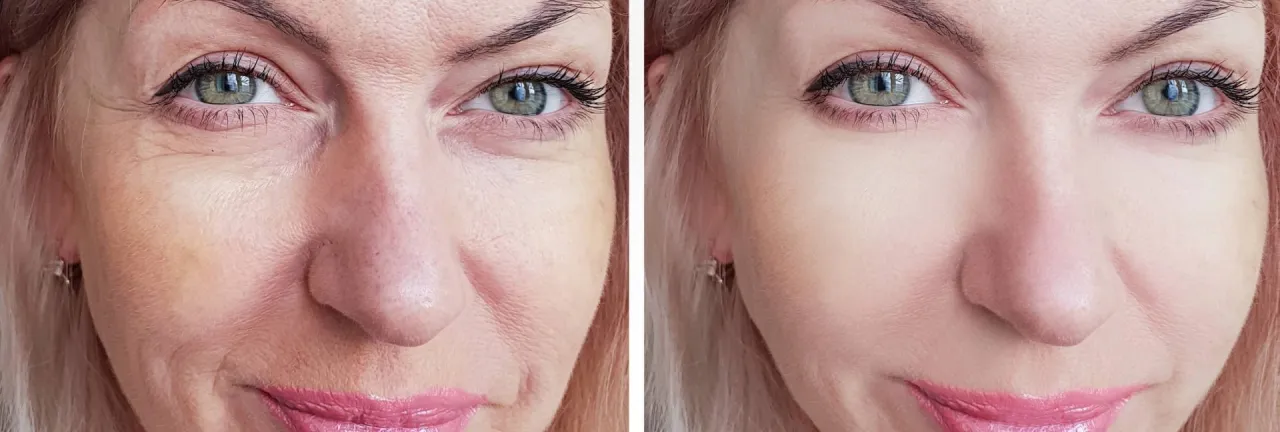 baby botox efekty naturalne