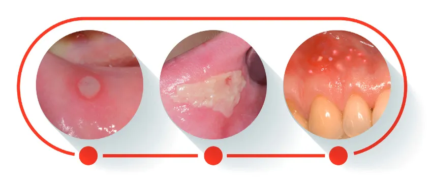 Afta na dziąśle wygląd rodzaje