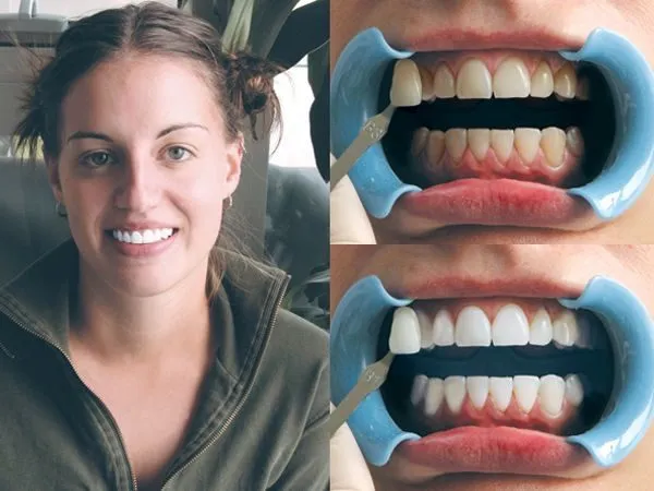 Wybielanie zębów lampą Beyond