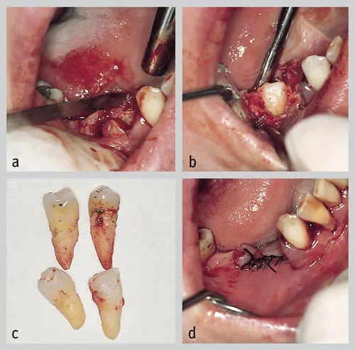 ekstrakcja chirurgiczna zęba zdjęcie