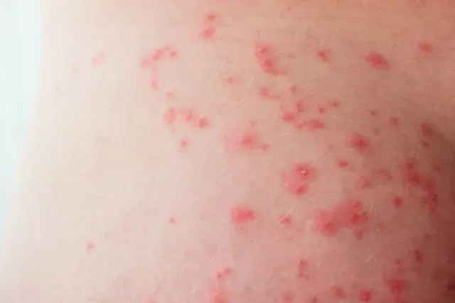 pryszcze na pośladkach rodzaje zmian skórnych