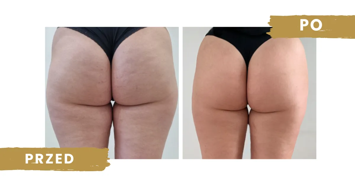 przed i po endermologia cellulit