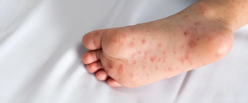 dziecko z bostonką objawy