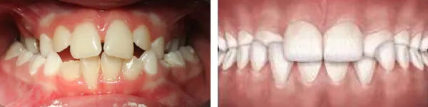 przykłady wad zgryzu g&oacute;rnego łuku