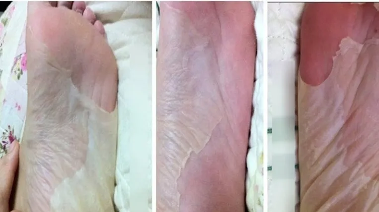 skarpetki złuszczające przed i po