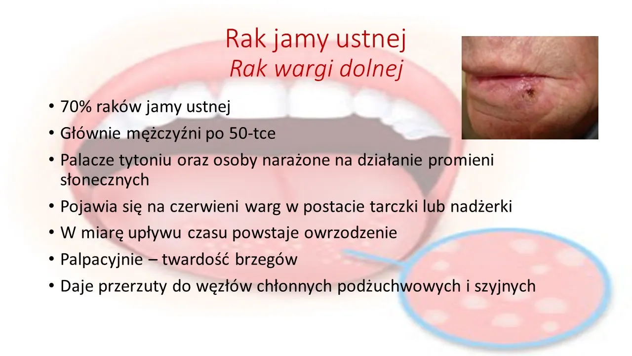 Zdjęcie Jak wygląda rak jamy ustnej: Jak rozpoznać raka jamy ustnej na podstawie wyglądu?