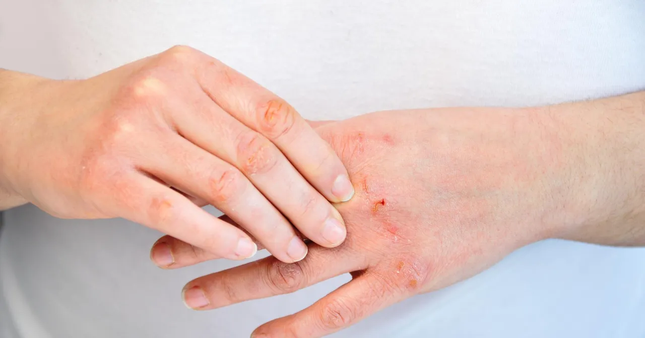 Zdjęcie Czy owies uczula? Objawy alergii i ryzyko dla zdrowia