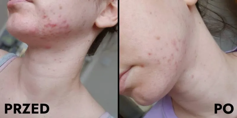 Zdjęcie Serum ASOA: Opinie, Skład i Efekty. Czy warto?