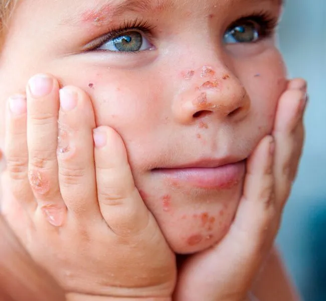 Zdjęcie Infecciones en la piel del rostro: causas, síntomas y tratamientos eficaces