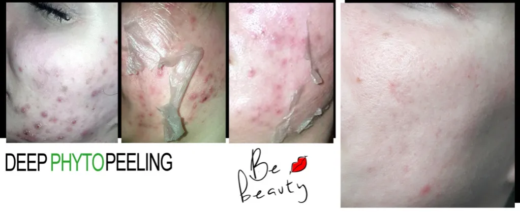 Zdjęcie Gdzie kupić deep phyto peeling i uniknąć nieefektywnych produktów