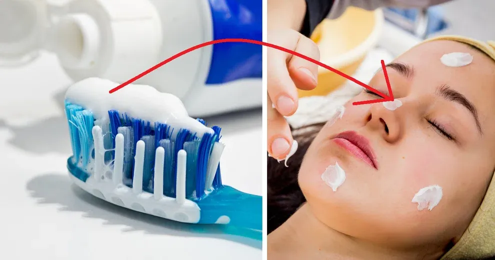 Zdjęcie Pasta na pryszcze: mit czy prawda? Bezpieczne sposoby na wypryski