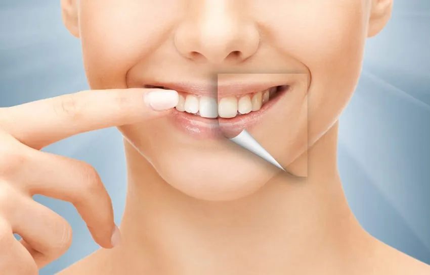Zdjęcie Ile kosztuje Hollywood Smile? Ceny zabiegów w Polsce i za granicą