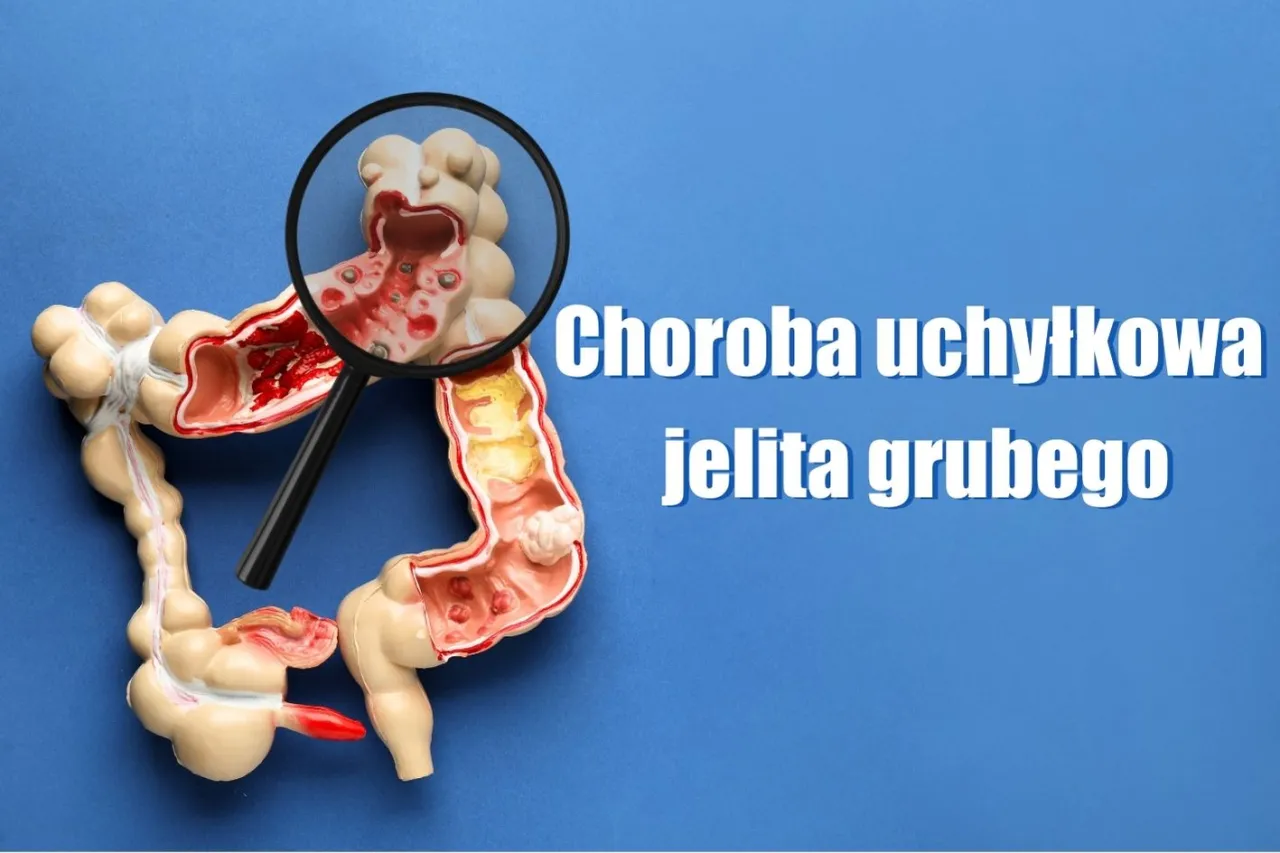 Zdjęcie Przepuklina jelita grubego objawy: rozpoznaj niebezpieczne sygnały