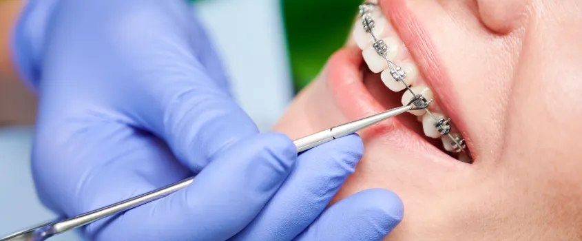 Zdjęcie Kiedy założyć aparat na zęby? Wiek, warunki i przeciwwskazania