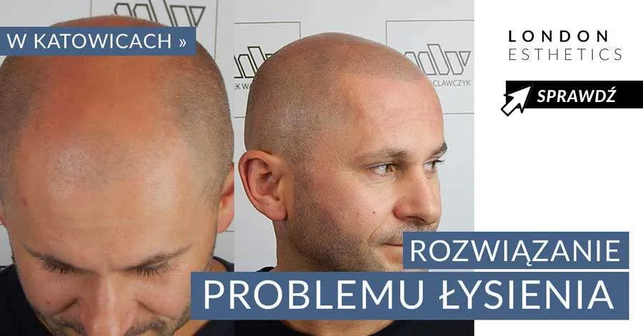 Zdjęcie Ile trzymać peeling na głowie? Uniknij błędów i zadbaj o skórę głowy