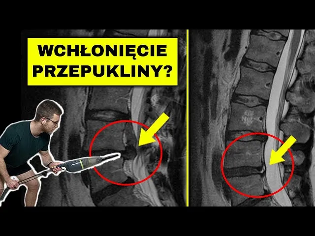 Zdjęcie Czy przepuklina kręgosłupa może się cofnąć? Fakty i mity