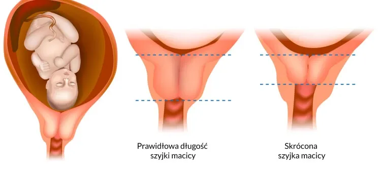 Zdjęcie Jak skutecznie zapobiec skracaniu szyjki macicy w ciąży i uniknąć zagrożeń