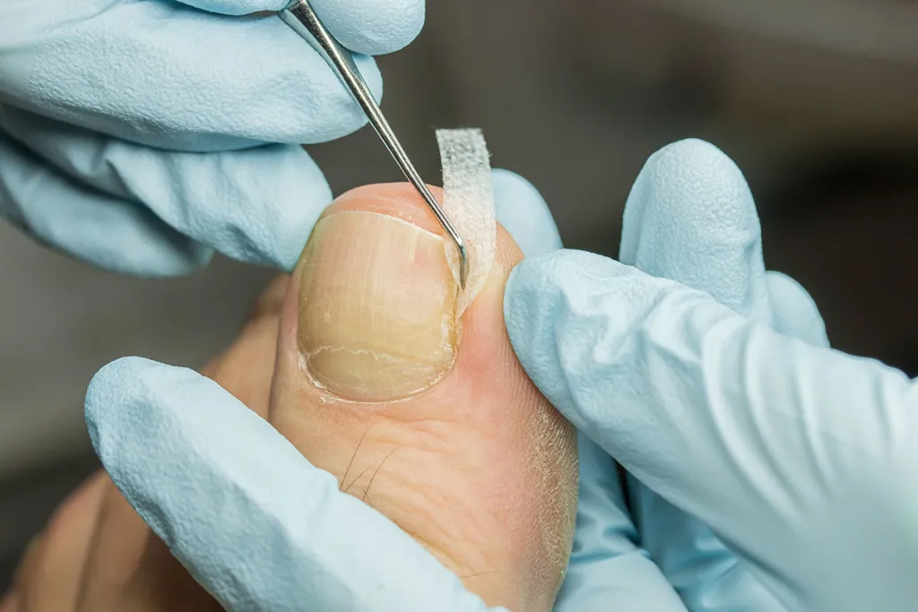 Zdjęcie Tamponada paznokcia: Ile trwa gojenie i jak przyspieszyć proces?