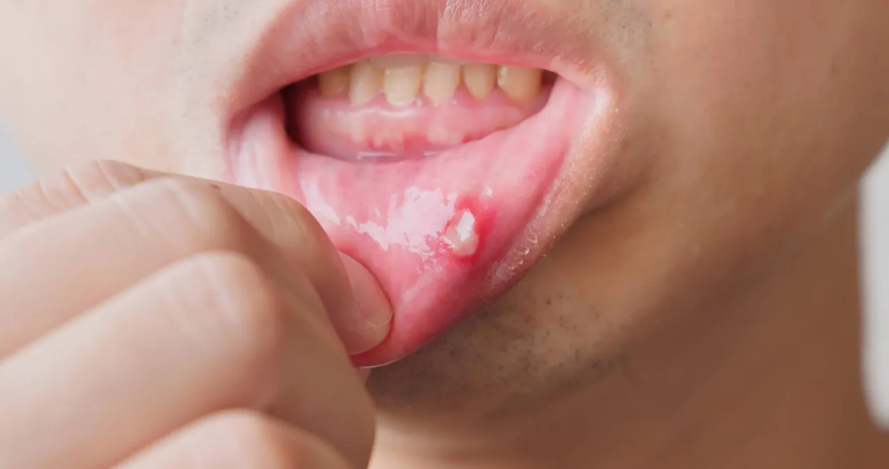 Zdjęcie Zapalenie jamy ustnej: Skuteczne sposoby na ból i dyskomfort