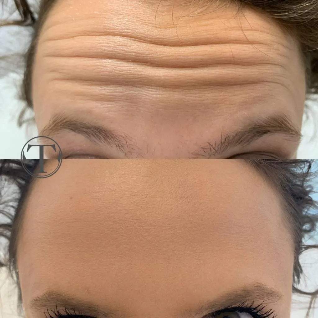 Zdjęcie Ile kosztuje botoks na kurze łapki? Ceny w Polsce i co wpływa na nie