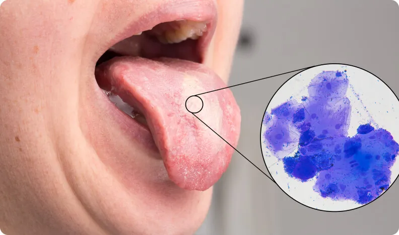 Zdjęcie Medikamente gegen Mundsoor: Effektive Lösungen für schnelle Linderung