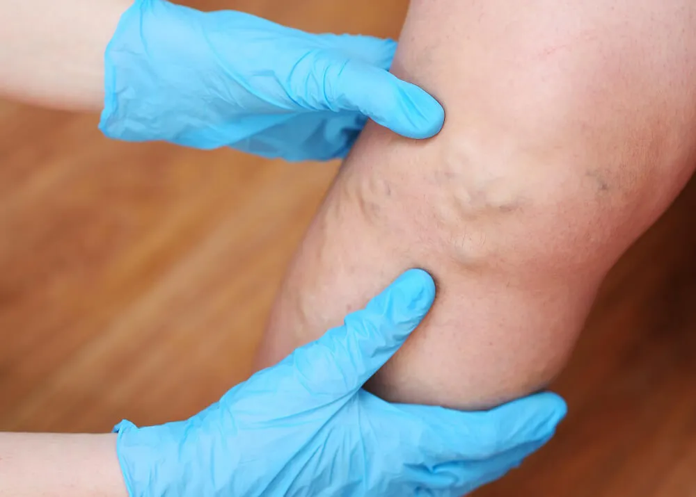 Zdjęcie Jak sprawdzić czy żyły są zatkane - objawy i skuteczne metody diagnozy