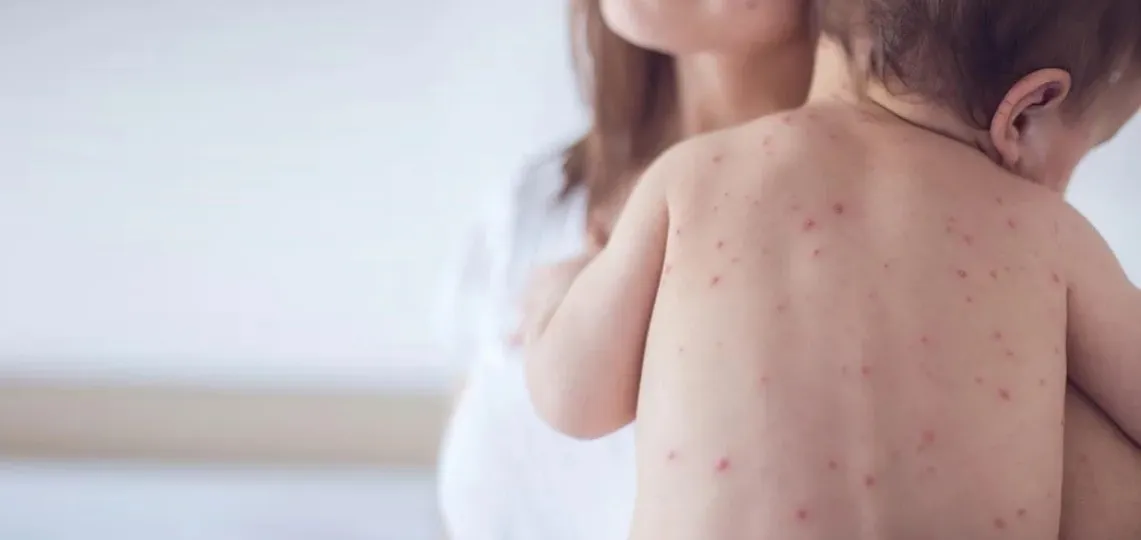 Zdjęcie Najczęstsze objawy odry u dzieci: rozpoznaj chorobę na wczesnym etapie