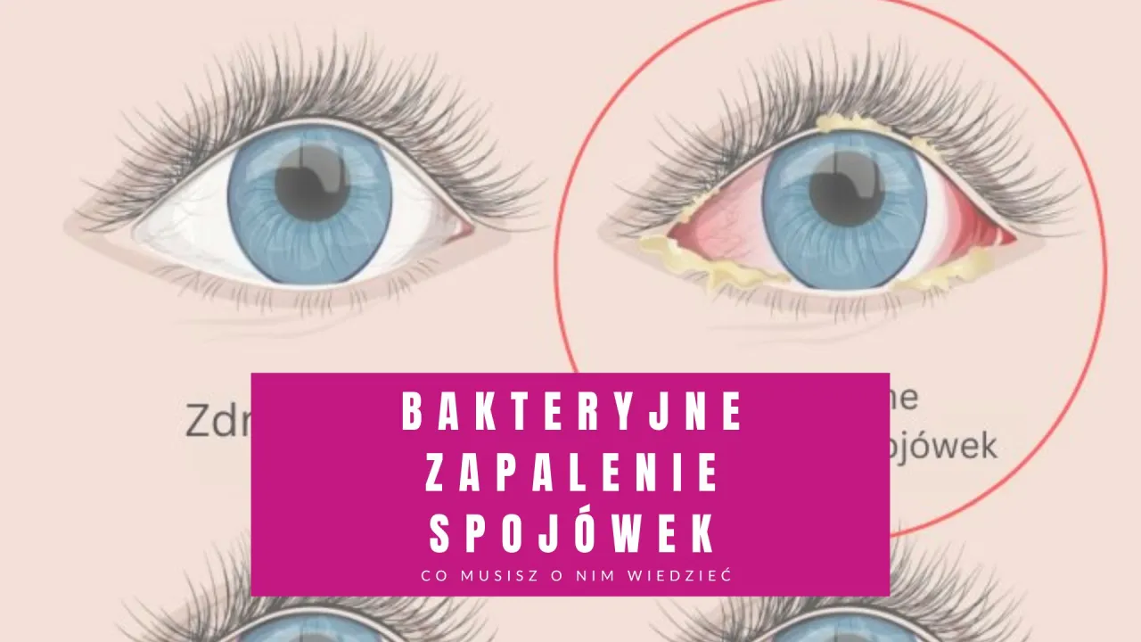 Zdjęcie Jak się przenosi zapalenie spojówek? Oto co musisz wiedzieć