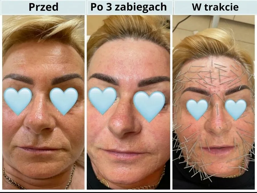 Zdjęcie Akupunktura Twarzy: Naturalny Lifting i Efekty Przed i Po