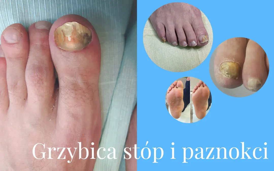 Zdjęcie Grzybica stóp objawy: Jak rozpoznać i uniknąć poważnych problemów