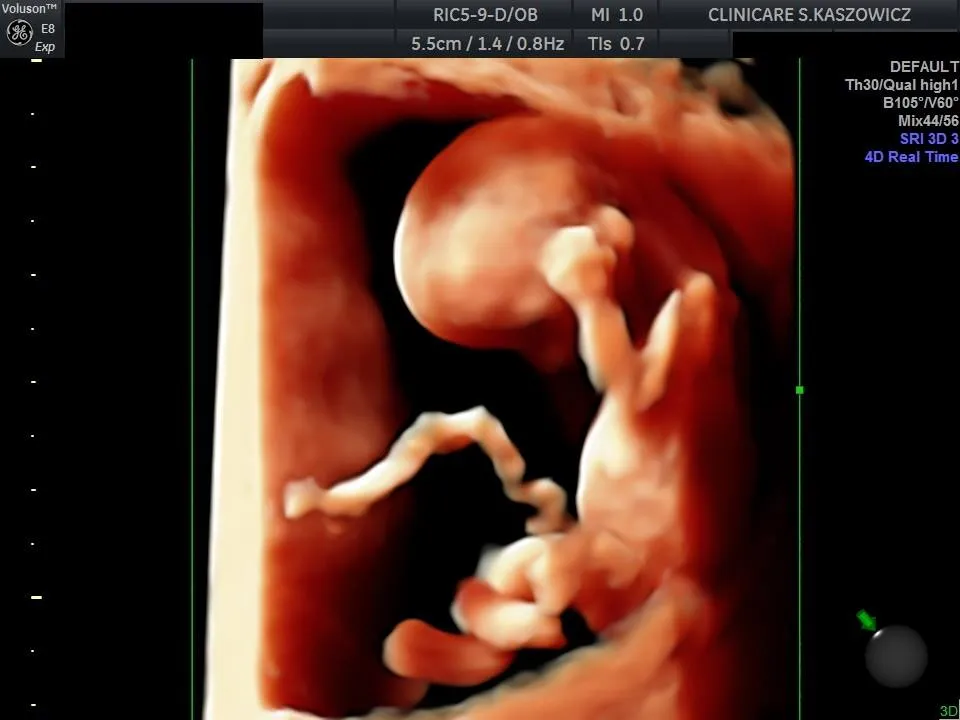 Zdjęcie Jak wygląda badanie prenatalne w 1 trymestrze? Co musisz wiedzieć