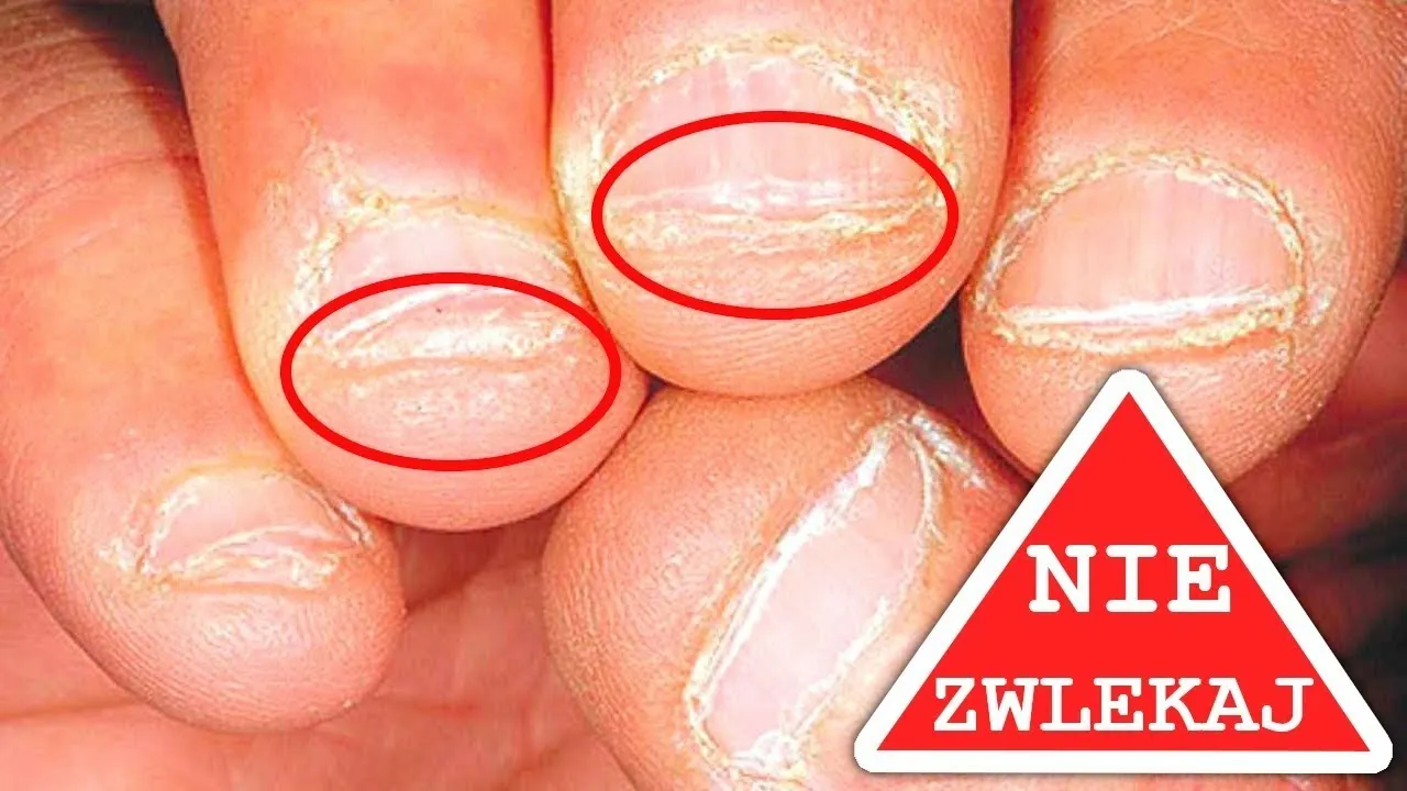 Zdjęcie Jak oduczyć się obgryzać paznokcie i odzyskać zdrowe dłonie