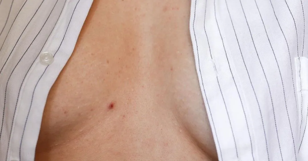 Zdjęcie Skuteczne sposoby na pozbycie się pryszczy na dekolcie i poprawę skóry