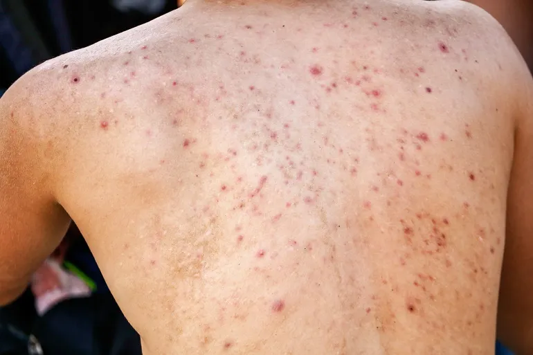 Zdjęcie Skuteczne sposoby na pryszcze na plecach – jak się ich pozbyć?