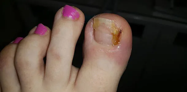 Zdjęcie Do jakiego lekarza z wrastającym paznokciem? Uniknij bólu i komplikacji