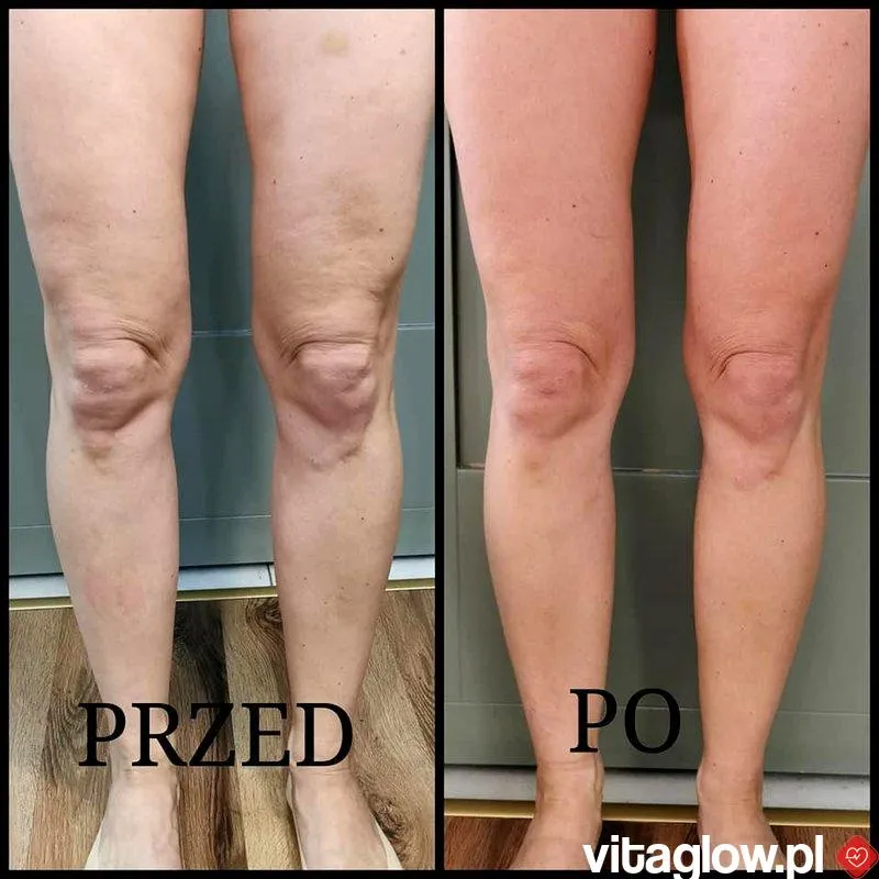 Zdjęcie Skuteczne sposoby na cellulit, które naprawdę działają i przynoszą efekty