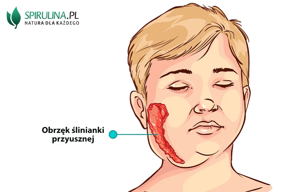Zdjęcie Świnka objawy: jak rozpoznać chorobę i uniknąć poważnych komplikacji
