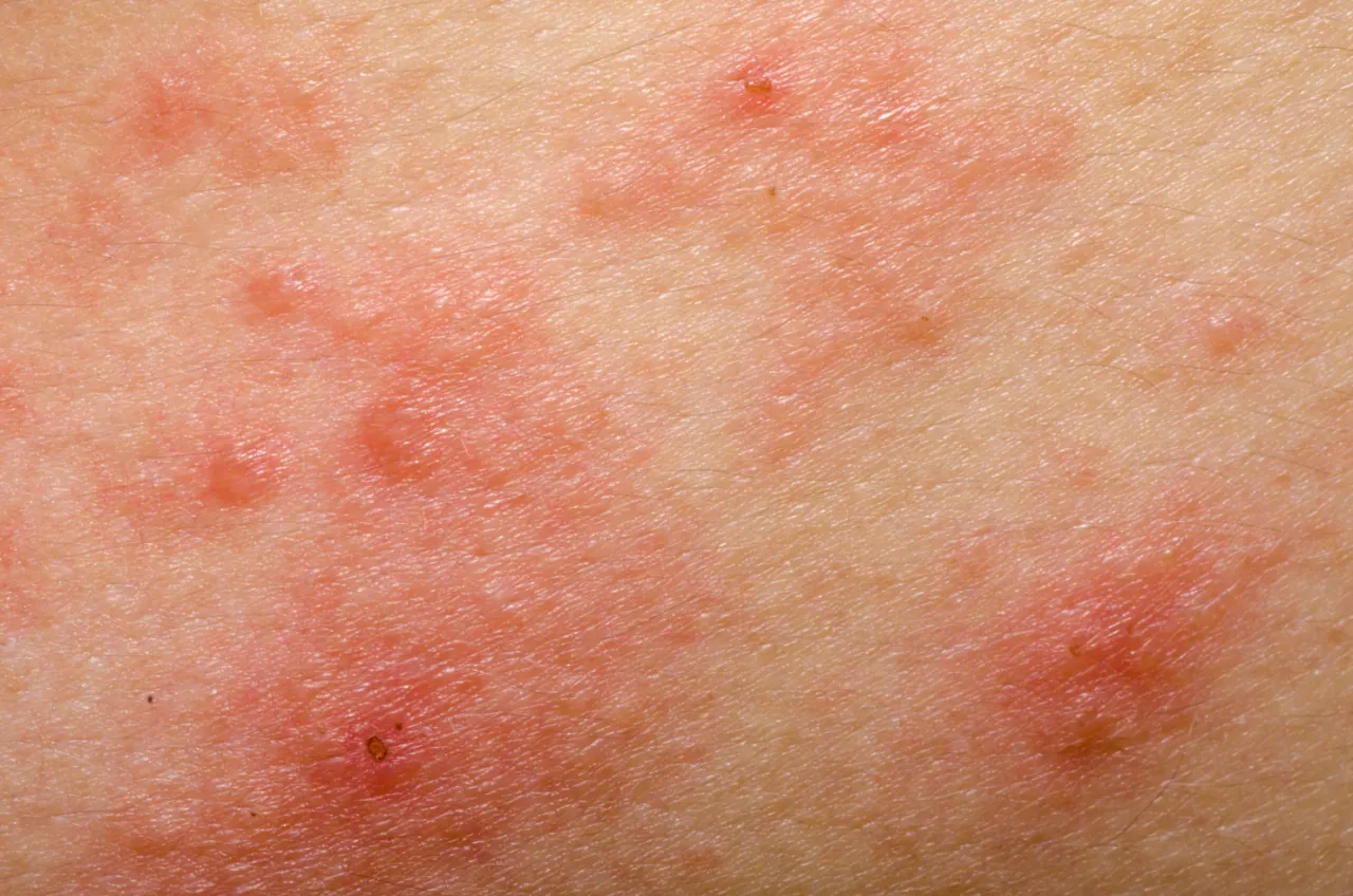 Zdjęcie Jak wygląda alergia? Objawy i charakterystyka reakcji skórnych