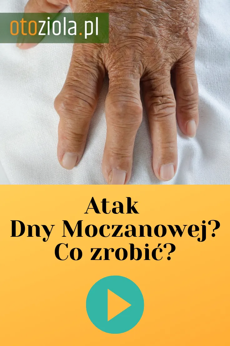Zdjęcie Skuteczne sposoby na złagodzenie bólu dny moczanowej i poprawę jakości życia