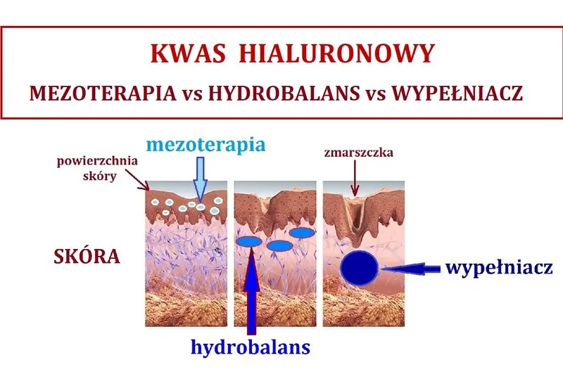Zdjęcie Jak głęboko wstrzykuje się kwas hialuronowy? Poznaj kluczowe informacje