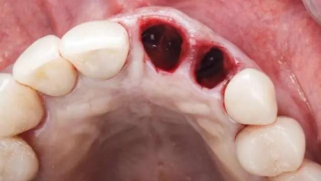 Zdjęcie Co na ból dziąsła po wyrwaniu zęba? Skuteczne metody ulgi i objawy