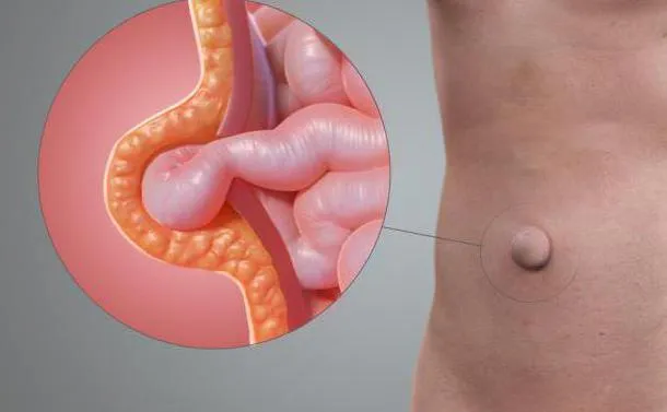 Zdjęcie Przepuklina: do jakiego lekarza się udać? Poradnik pacjenta