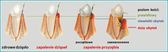 Zdjęcie Jak skutecznie leczyć chore dziąsła i uniknąć bólu oraz problemów